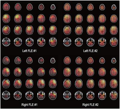 Heart rate variability as a preictal marker for determining the laterality of seizure onset zone in frontal lobe epilepsy